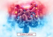 Colon Cancer Treatment